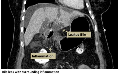 b4il3e leaks|Bile Leak